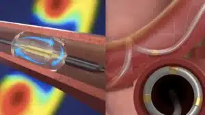 what is renal denervation