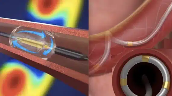 what is renal denervation