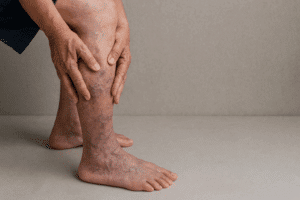 A person's legs with visible varicose veins, emphasizing the need for the best exercises for managing PAD symptoms.